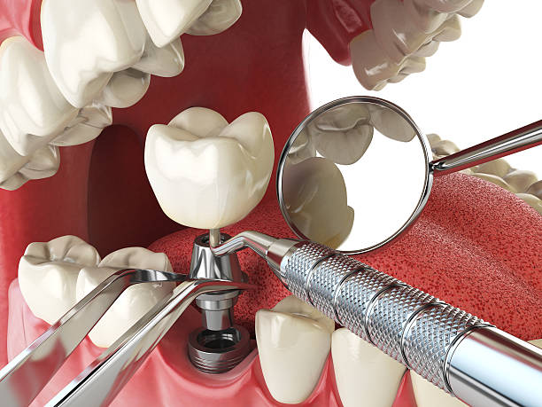 Best Emergency Tooth Extraction in Junction City, KY
